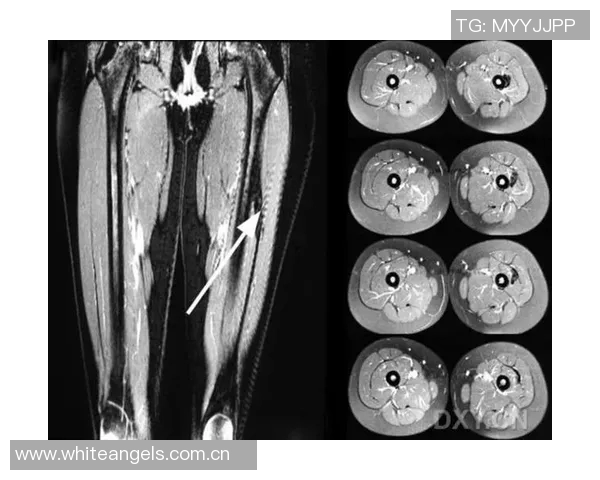 李磊右大腿后群肌肉拉伤及肌筋膜炎I的伤情报告分析与康复建议 李磊右大腿后群肌肉拉伤及肌筋膜炎I的伤情报告分析与康复建议
